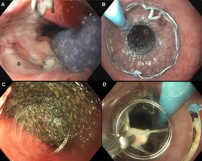 Vacuum-stent: A combination of endoscopic vacuum therapy and an intraluminal stent for treatment of esophageal transmural defects
